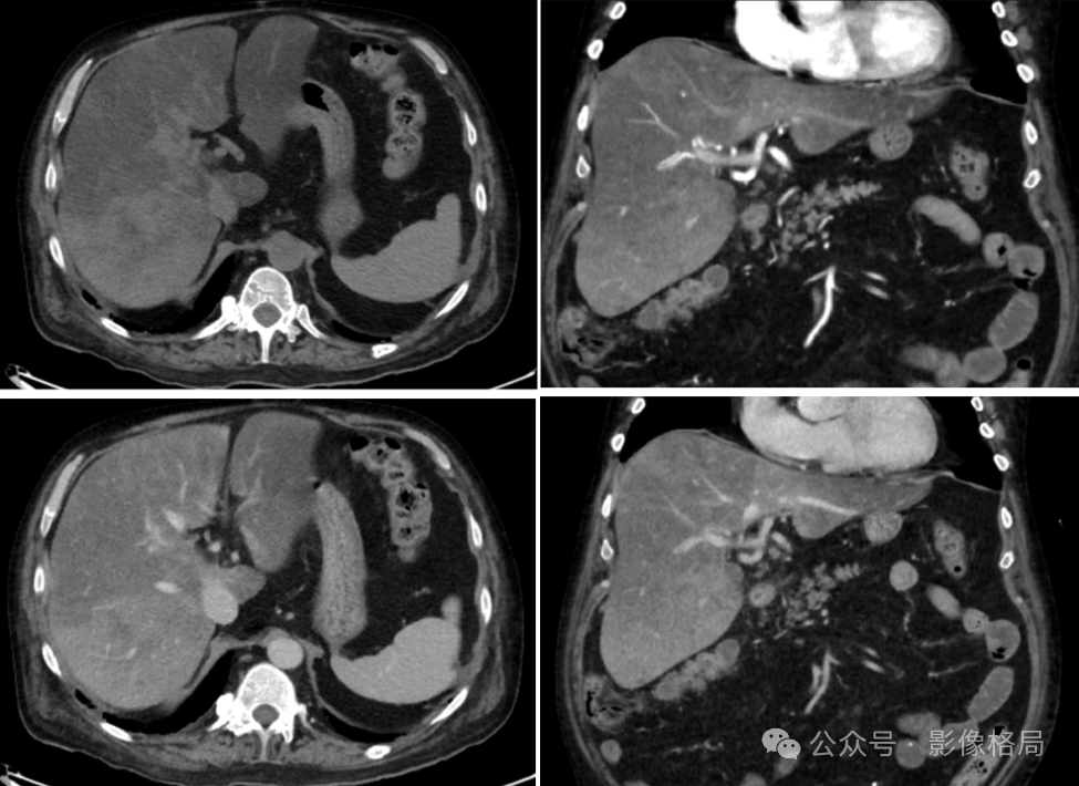 Multifocal Hepatic Steatosis