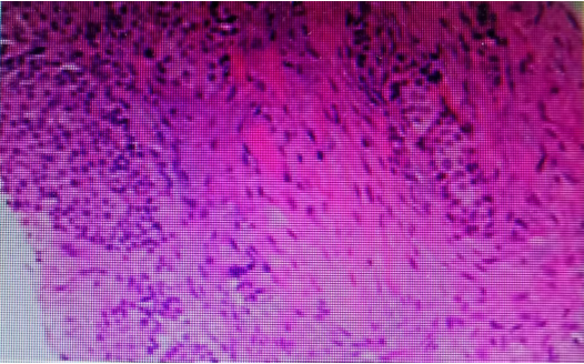 Case Sharing | The Combination of Surgery, Radiotherapy, ADC, and Immunotherapy for High-Risk Invasive Urothelial Carcinoma