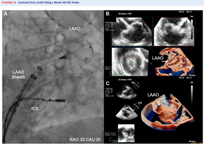 Comprehensive Review: Left Atrial Appendage Occlusion - Progress and Challenges