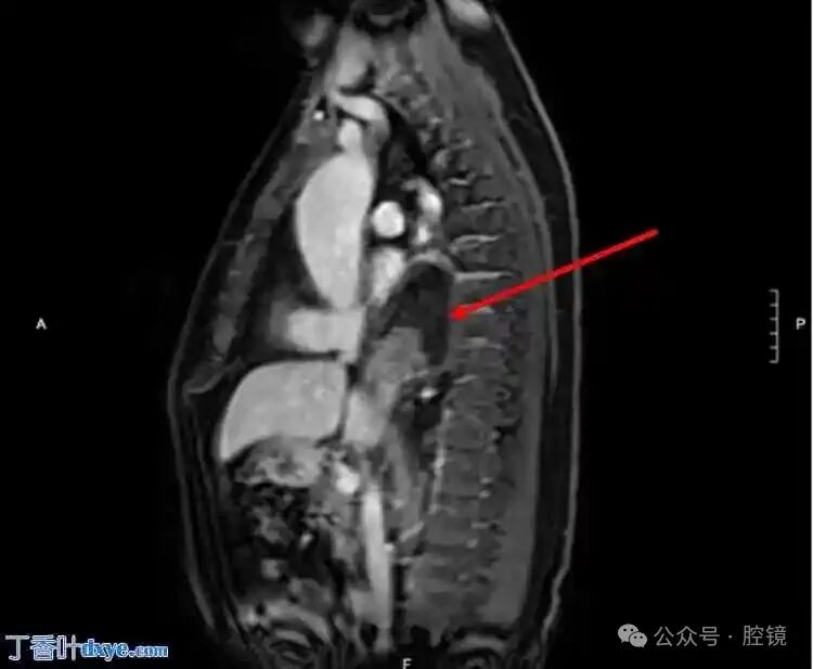 Successful Repair of a Rare Esophageal Hiatal Hernia Case Using Robotic-Assisted Surgery