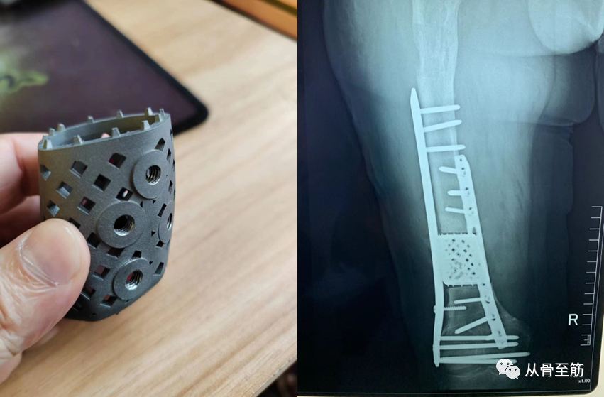 Applications of 3D Printing Technology in Orthopedics