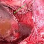 Successful Repair of a Rare Esophageal Hiatal Hernia Case Using Robotic-Assisted Surgery