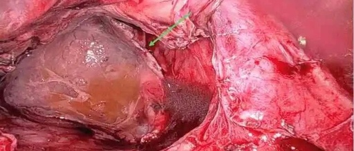 Successful Repair of a Rare Esophageal Hiatal Hernia Case Using Robotic-Assisted Surgery