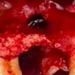 Literature Review: Application of Customized 3D-Printed Titanium Mesh in Complex Bone Defects after Odontectomy in the Aesthetic Zone: A Case Report