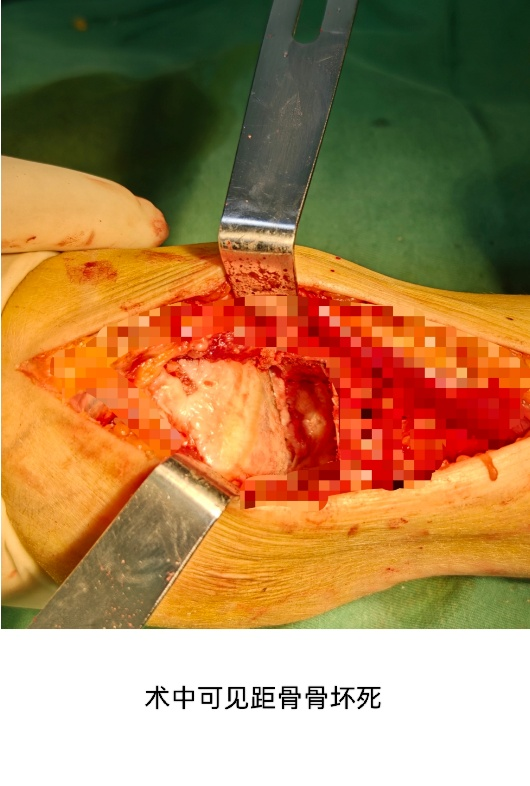 Case Study: Lixian Traditional Chinese Medicine Hospital Orthopedics Performs "3D Printed Guide-Assisted Total Ankle Joint Replacement Surgery"