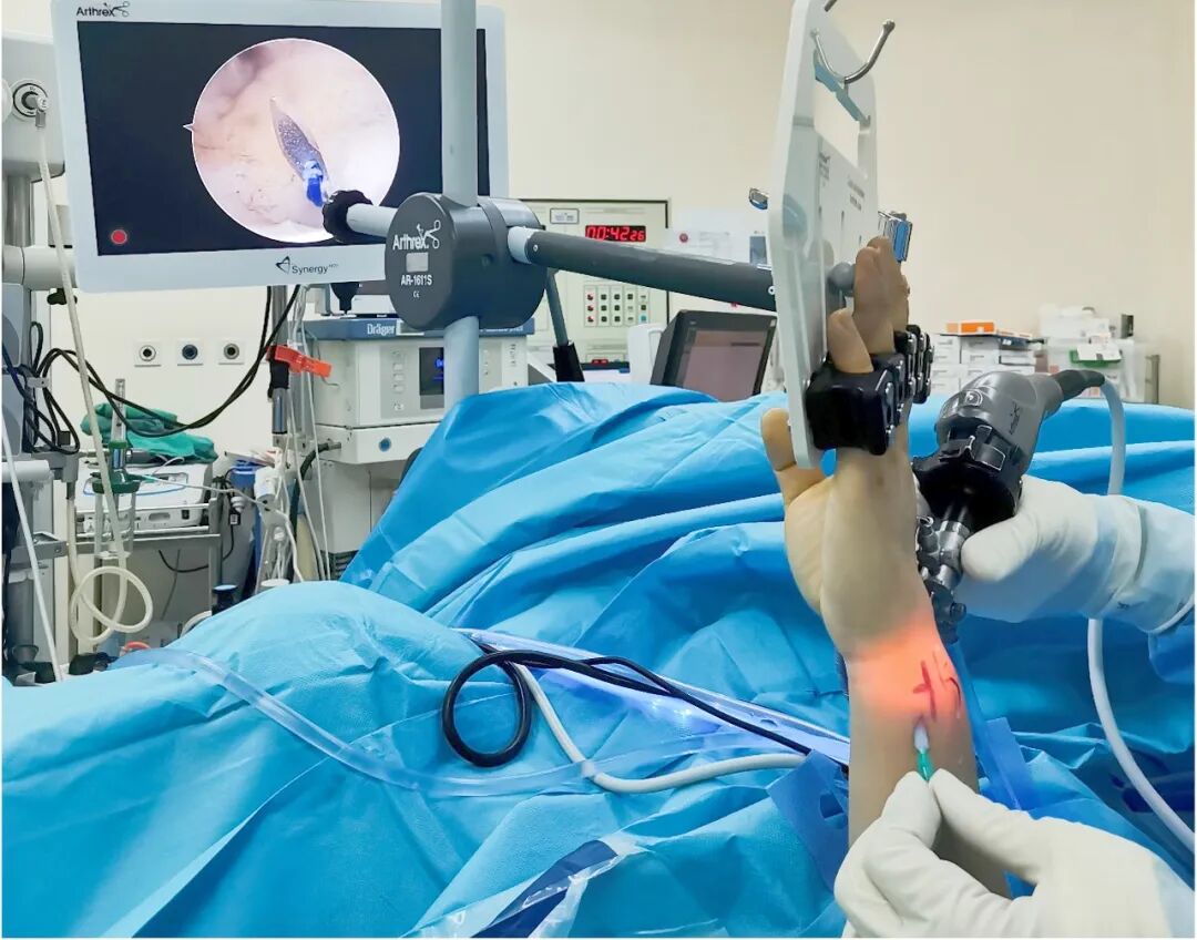 3D Printing & Precision Minimally Invasive Surgery: Wrist Arthroscopy Helps TFCC Patients Regain Athletic Vitality