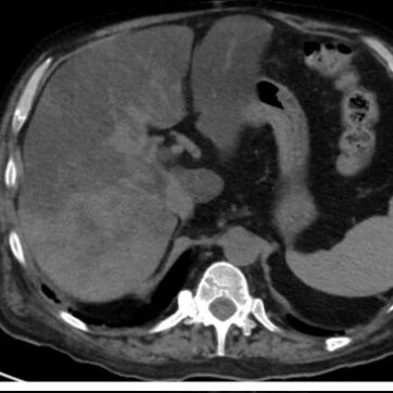 Multifocal Hepatic Steatosis