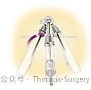 Sternum-Based Single-Port Robotic Thymectomy Using the Da Vinci Xi System