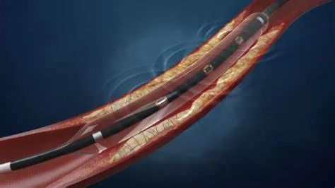 Intravascular Shockwave Balloon Catheter: Key Shockwave Patent Invalidated, Is a Spring for Domestic Devices Approaching?