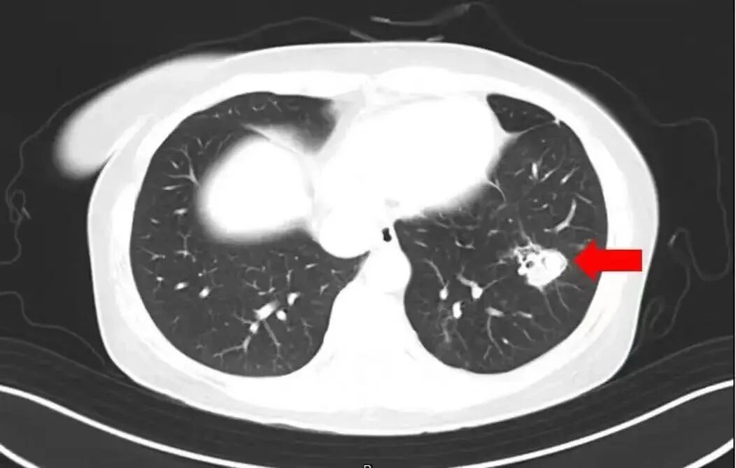 High Fever of 40°C After Spring Cleaning: Beware of Mold in the Lungs!