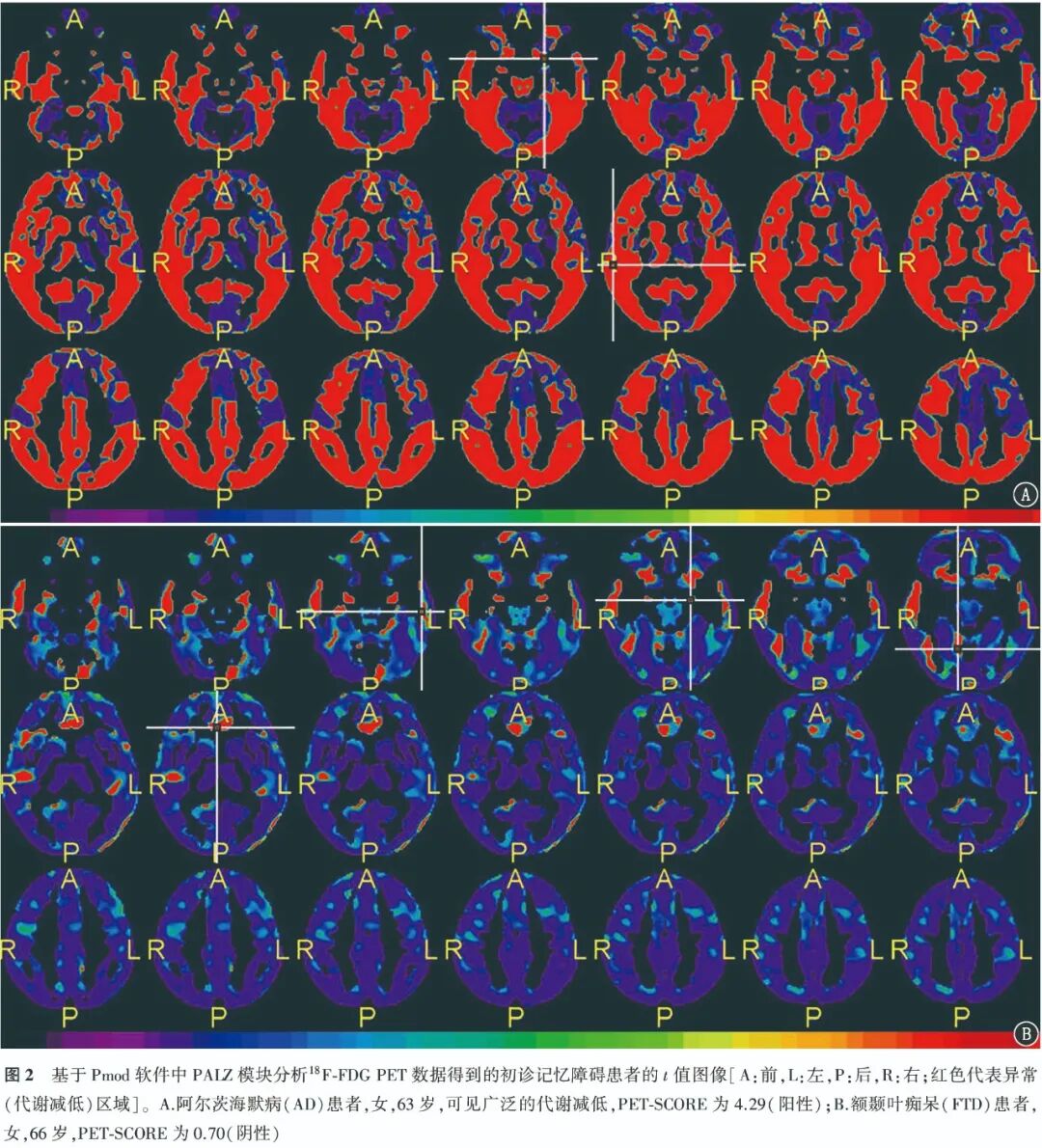 The Efficacy of 18F-FDG PET in Diagnosing Alzheimer's Disease in Patients with Memory Impairment