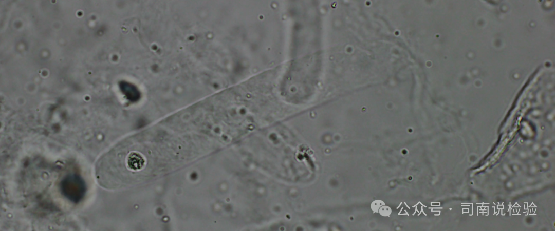 Morphology 121: Urine - Transparent Casts (Instrument-Assisted Diagnosis)