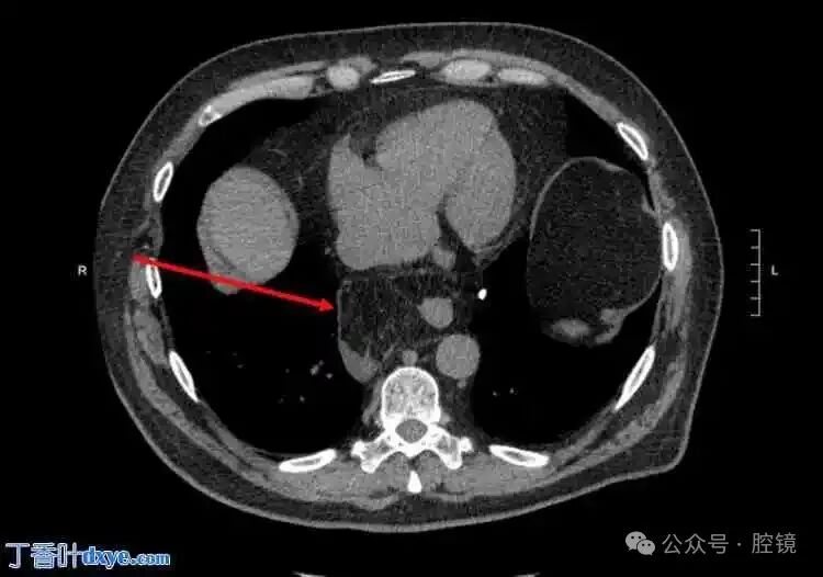Successful Repair of a Rare Esophageal Hiatal Hernia Case Using Robotic-Assisted Surgery