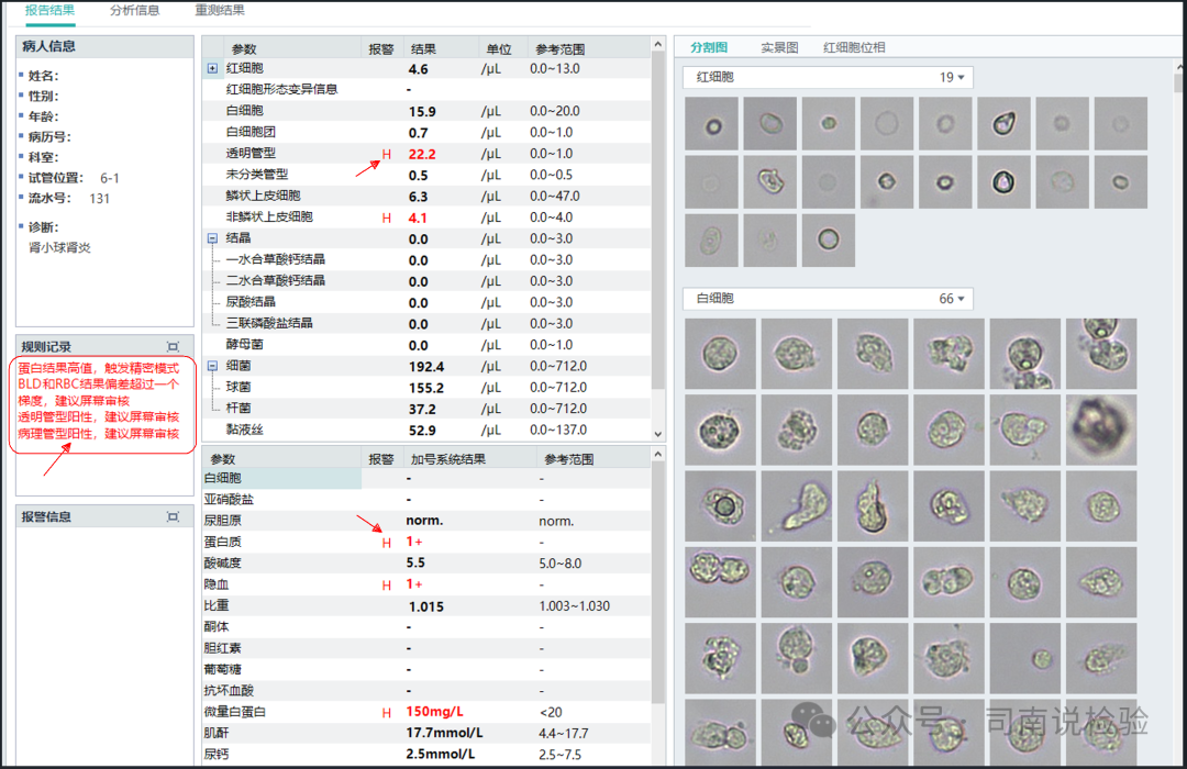 Morphology 121: Urine - Transparent Casts (Instrument-Assisted Diagnosis)