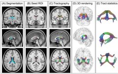 Cerebral Cortex: Professor Xu Haibo's Team at Wuhan University Applies 5.0 T Ultra-High-Resolution Diffusion Imaging to Reveal Lifelong Development Trajectories of the Human Fornix