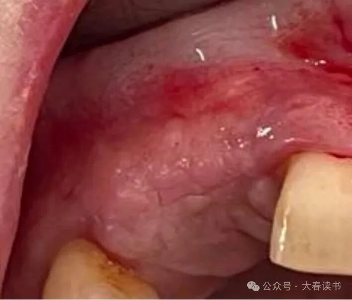 Literature Review: Application of Customized 3D-Printed Titanium Mesh in Complex Bone Defects after Odontectomy in the Aesthetic Zone: A Case Report