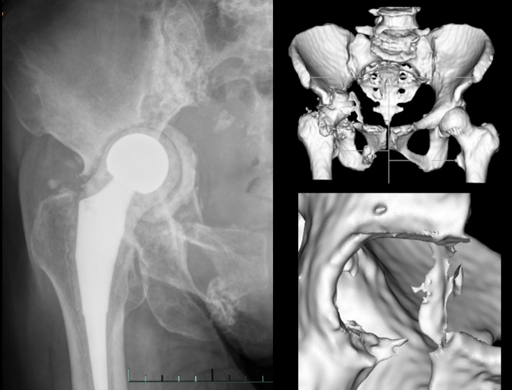 Robotic Navigation and AI for Custom Hip Joint Reconstruction: A World-First Approach to Bone Repair