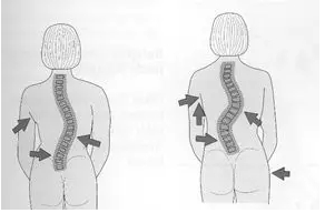 3D Printed Scoliosis Orthosis: Technology Straightens the Spine for Adolescents