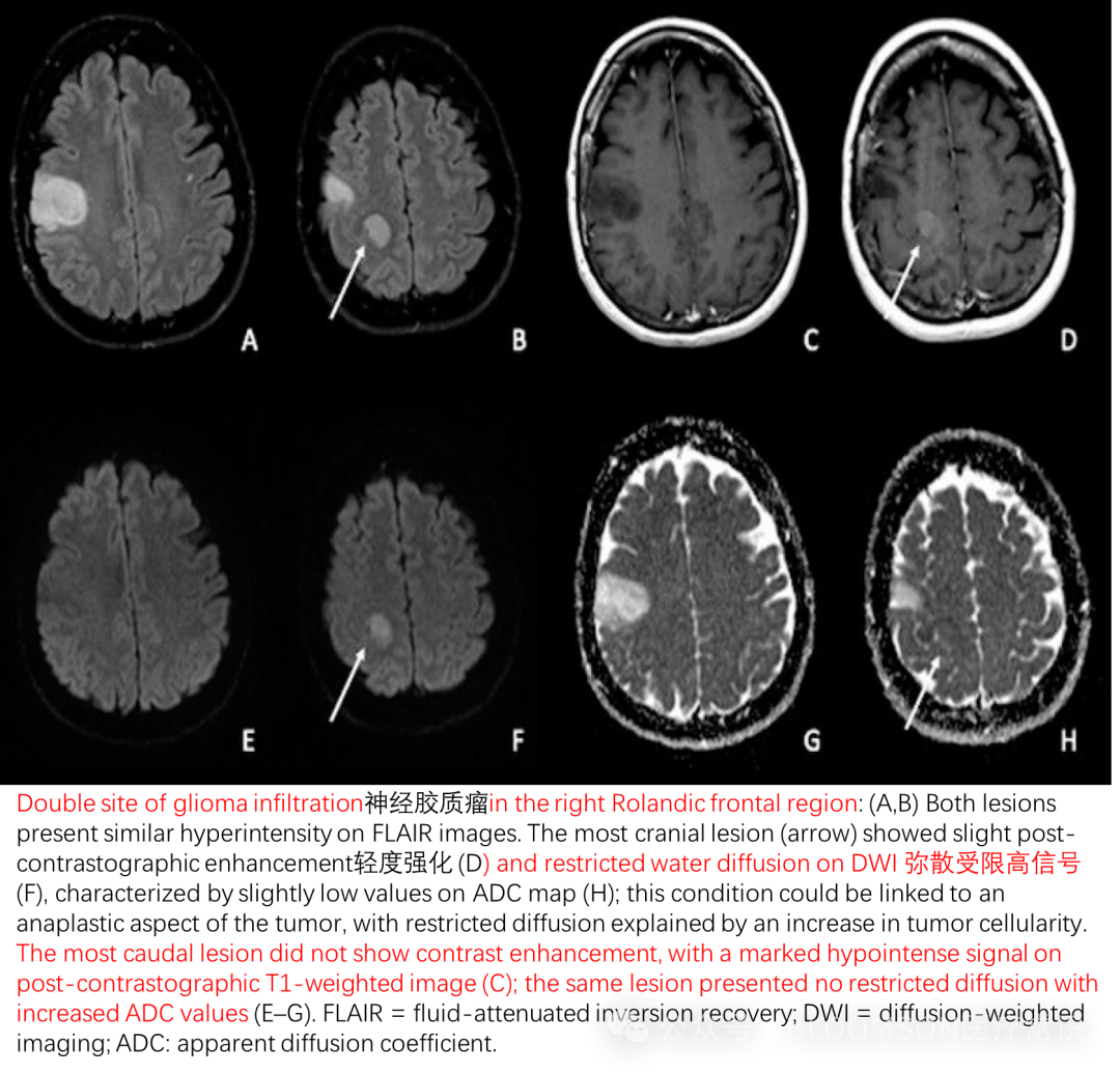 Overview of DWI and ADC Values in MRI