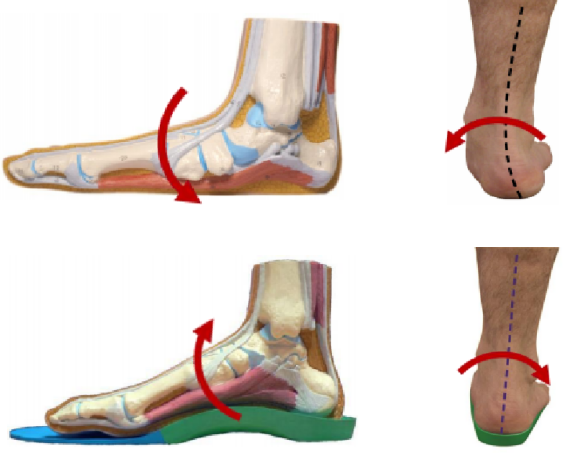 Customizing Foot Arches: The Revolution of 3D Printing