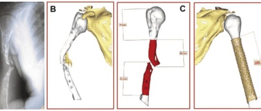 3D Printing of PEEK (Polyether Ether Ketone) for Treating Humeral Fractures Caused by Gunshot Wounds in the Russia-Ukraine War