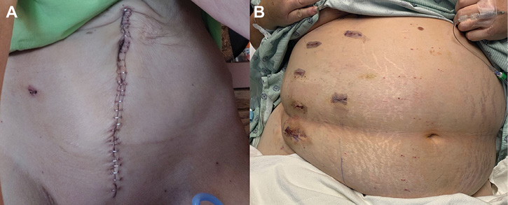 Robotic Ileal Ureter Replacement: Addressing Severe Ureteral Strictures