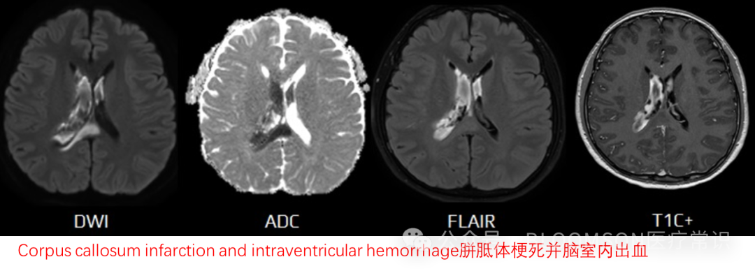 Overview of DWI and ADC Values in MRI