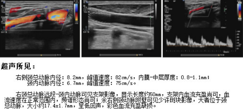Application of the C-Balloon® Catheter Combined with the PathGuard® Umbrella for Endovascular Treatment of Floating Thrombus at the Carotid Artery Bifurcation