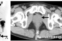 The Value of miPSMA Scoring in Diagnosing Prostate Cancer Using (68)Ga-PSMA-11 PET/CT Imaging