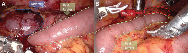 Robotic Ileal Ureter Replacement: Addressing Severe Ureteral Strictures