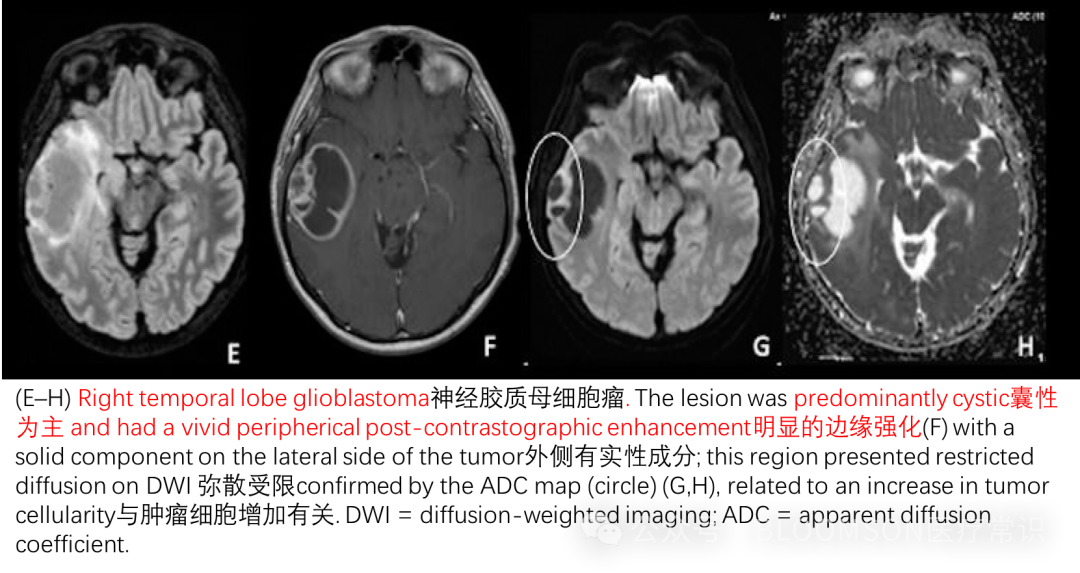 Overview of DWI and ADC Values in MRI