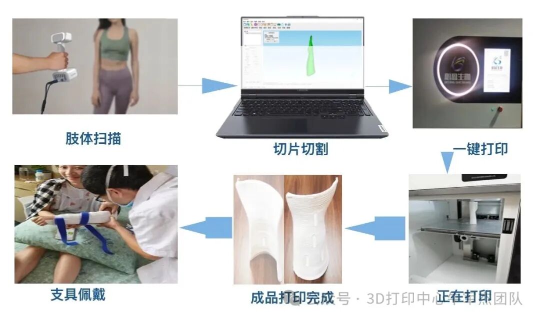 Goodbye to Heavy Plaster: Instant 3D Printing for Precise Orthopedic Rehabilitation!