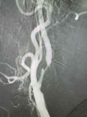 Application of the C-Balloon® Catheter Combined with the PathGuard® Umbrella for Endovascular Treatment of Floating Thrombus at the Carotid Artery Bifurcation
