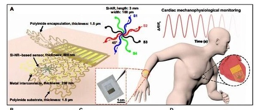 Electronic Tattoos for the Heart: Biodegradable Strain Sensors for Real-Time Detection of Myocardial Infarction