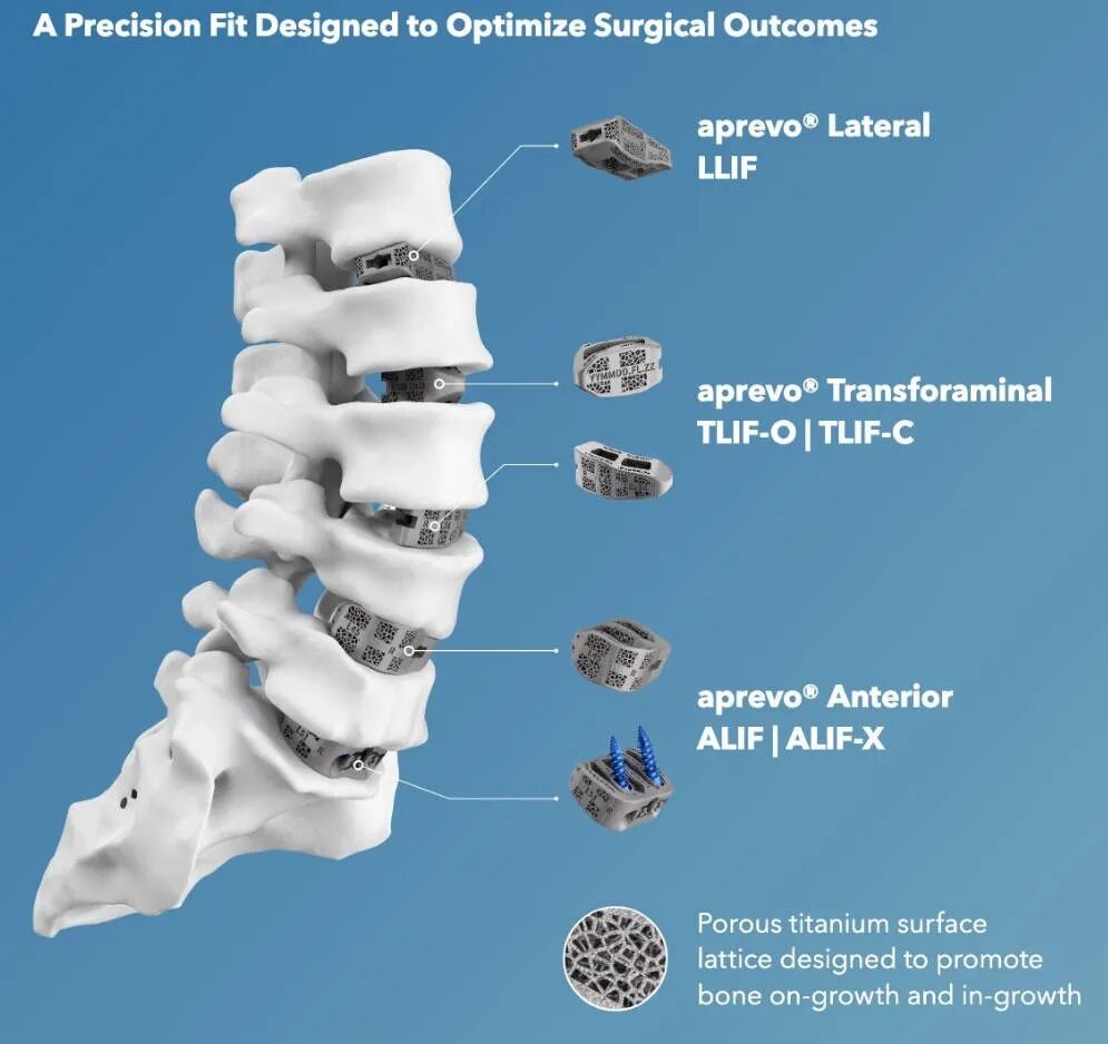 Metal 3D Printing of Orthopedic Implants Becomes an Investment Hotspot