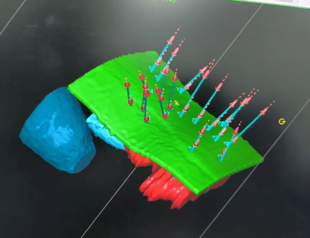 3D Printing Precision Guidance for Large Segment Implant Radiation Therapy Successfully Targets Complex Uterine Sarcoma Metastases