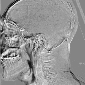 Application of the C-Balloon® Catheter Combined with the PathGuard® Umbrella for Endovascular Treatment of Floating Thrombus at the Carotid Artery Bifurcation