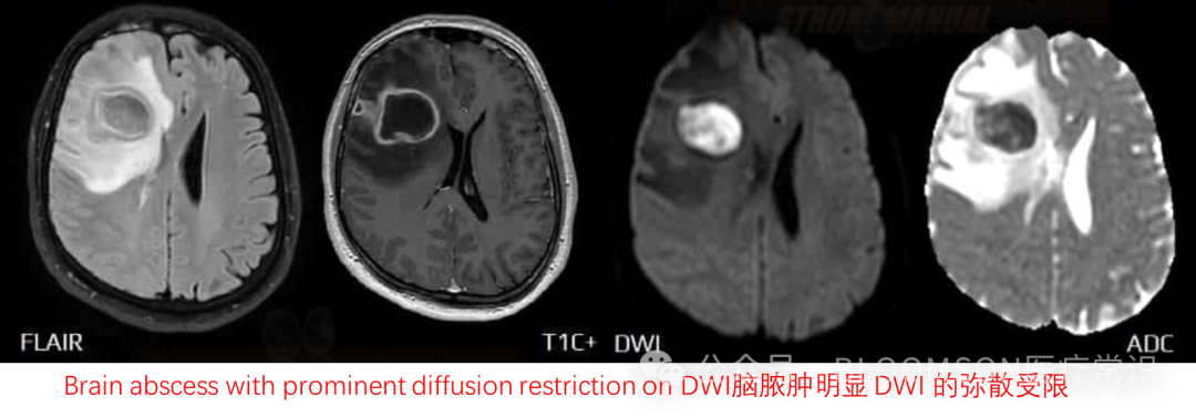 Overview of DWI and ADC Values in MRI