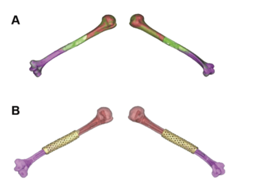 3D Printing of PEEK (Polyether Ether Ketone) for Treating Humeral Fractures Caused by Gunshot Wounds in the Russia-Ukraine War