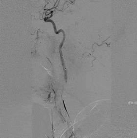 Application of the C-Balloon® Catheter Combined with the PathGuard® Umbrella for Endovascular Treatment of Floating Thrombus at the Carotid Artery Bifurcation