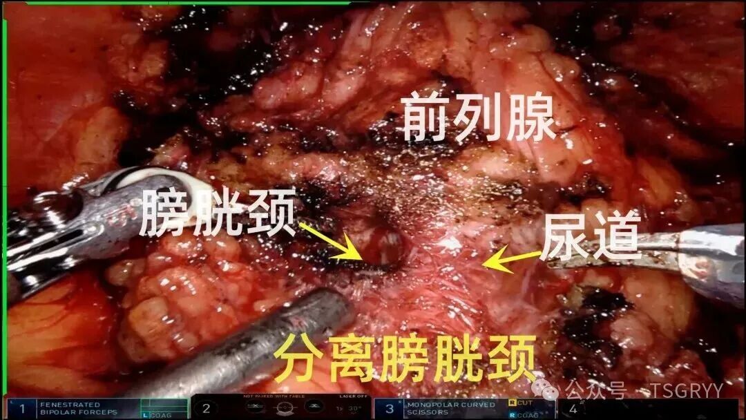 Precision Minimally Invasive Surgery: Safeguarding Life's Glands