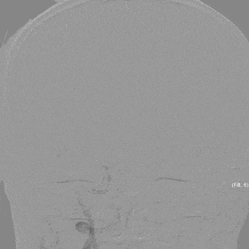 Application of the C-Balloon® Catheter Combined with the PathGuard® Umbrella for Endovascular Treatment of Floating Thrombus at the Carotid Artery Bifurcation
