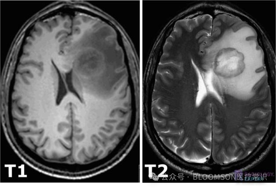 Overview of DWI and ADC Values in MRI