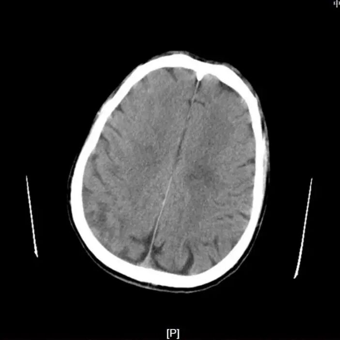Application of the C-Balloon® Catheter Combined with the PathGuard® Umbrella for Endovascular Treatment of Floating Thrombus at the Carotid Artery Bifurcation