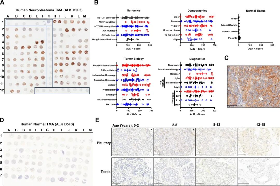 ALK-ADC Drug: Validation of Efficacy of ALK-Targeted Humanized Antibody-Drug Conjugate with Pyrrolobenzodiazepine Payload in ALK-Expressing Cancers