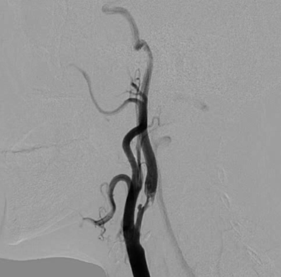 Application of the C-Balloon® Catheter Combined with the PathGuard® Umbrella for Endovascular Treatment of Floating Thrombus at the Carotid Artery Bifurcation