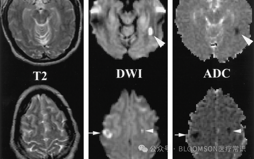 Overview of DWI and ADC Values in MRI
