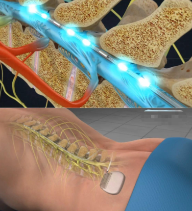 Spinal Cord 'Circuit Board' Damage? Decoding Neural Repair Technology: From Stem Cells to Electrical Stimulation, Restarting the Human 'Superpower' Blueprint!