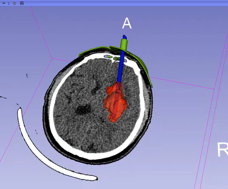 How 3D Printing Enables One-Click Customization of Minimally Invasive Hemorrhage Solutions