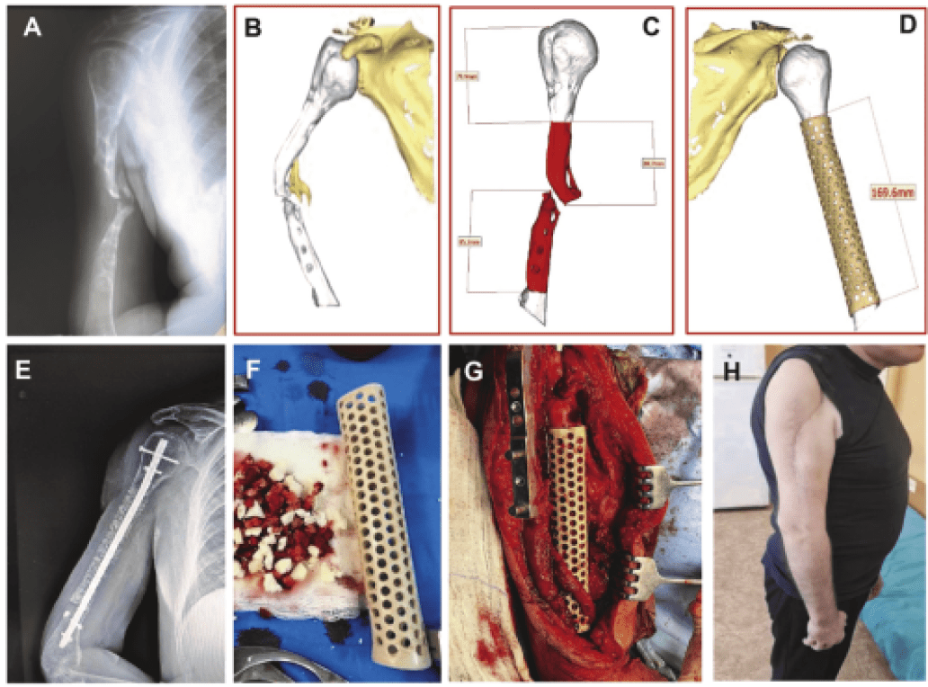 3D Printing of PEEK (Polyether Ether Ketone) for Treating Humeral Fractures Caused by Gunshot Wounds in the Russia-Ukraine War